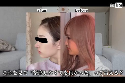 美容整形ビフォーアフターを示す伊藤桃々
