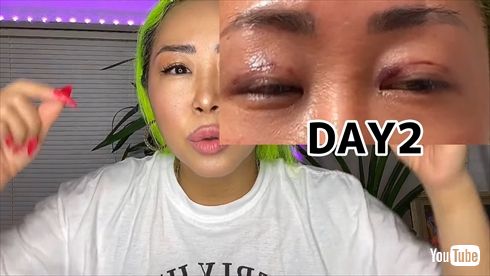 二重埋没法のダウンタイムをレポートするMr.マリックの娘・LUNAの