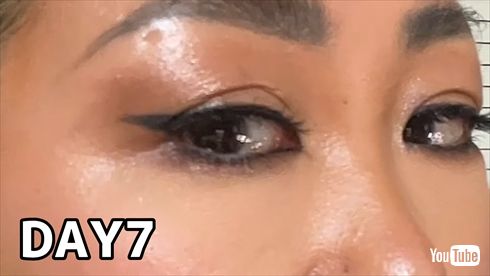 二重埋没法のダウンタイムをレポートするMr.マリックの娘・LUNAの