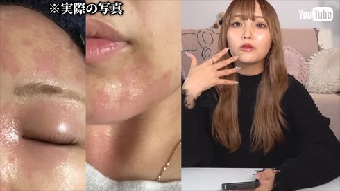 アナフィラキシーショックで死にかけたYouTubeのねお