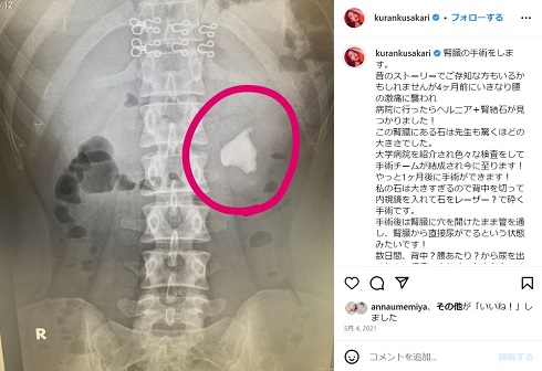 紅蘭の腎結石レントゲン写真