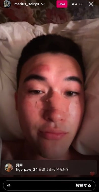 プールの飛び込みでけがした元「Sexy Zone」マリウス葉