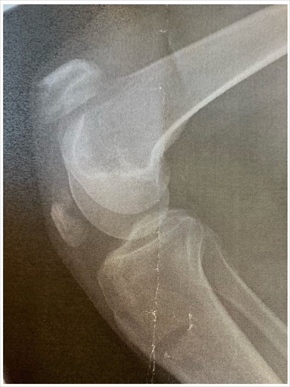 左膝の皿を骨折したLiLiCo