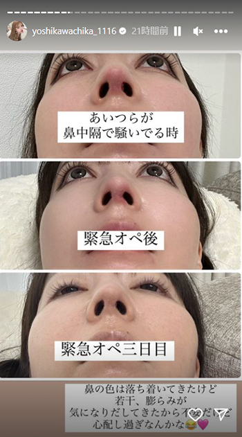 腫れと膿が出てしまった鼻