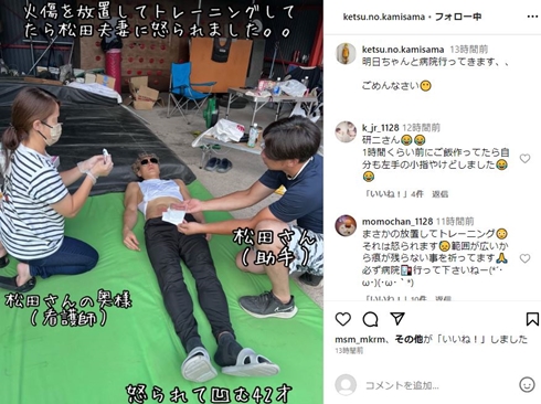 樽美酒研二火傷