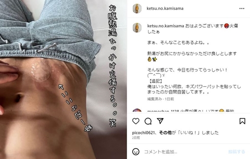 樽美酒研二火傷