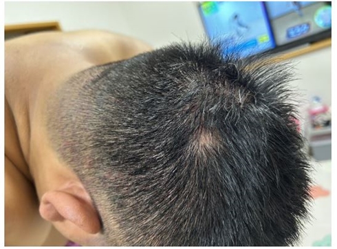 チェリー吉武円形脱毛症