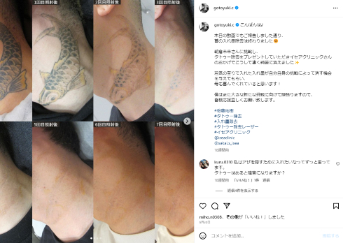 首のタトゥーを除去した千葉県八街市議会議員で後藤真希の弟・後藤祐樹