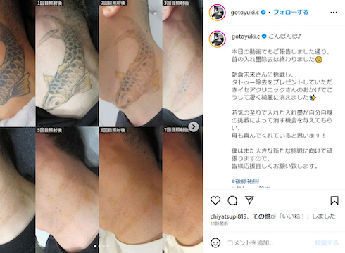 首のタトゥーの施術過程を示す後藤祐樹