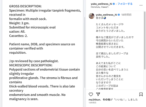 高沢悠子が公開した子宮ポリープの検査結果