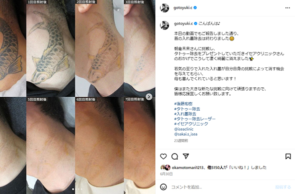 首のタトゥー除去の様子