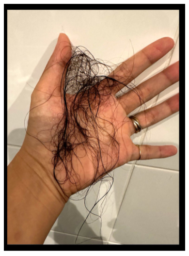 産後の大量の抜け毛に悩まされるギャル曽根