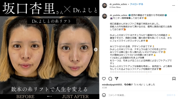 坂口杏里の糸リフト前後
