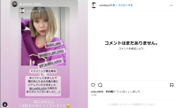 糸リフトした坂口杏里