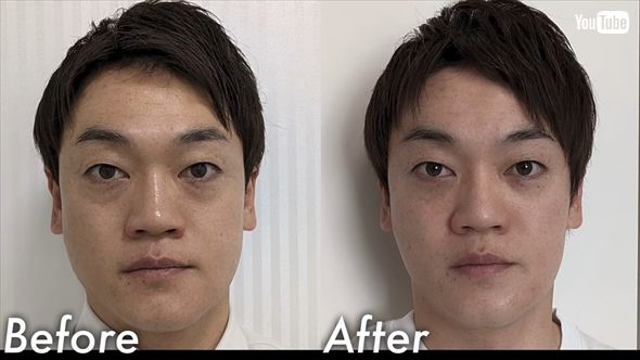 100万円かけて美容整形したおばたのお兄さんのビフォーアフター