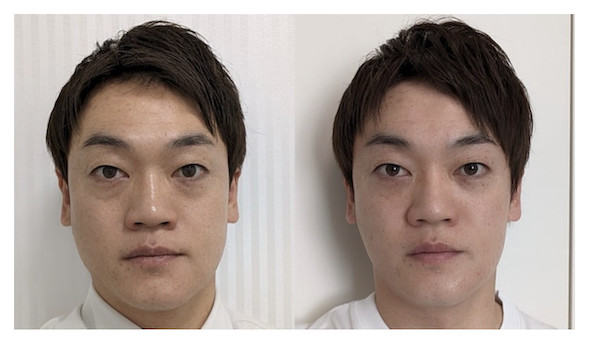 おばたのお兄さんの整形ビフォーアフター