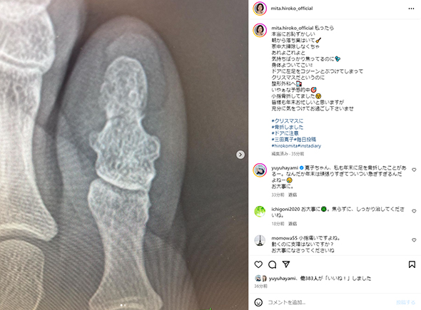 小指を骨折した三田寛子