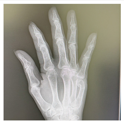 小柳ルミ子骨折