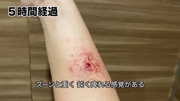 深海 巨大魚 毒針 生物 ウスエイ 尾 トゲ 毒棘 腕を刺されたら