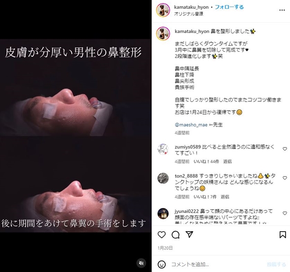 カマたく整形失敗