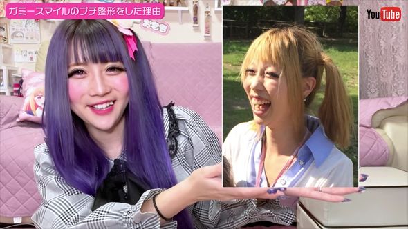 ガミースマイルを改善する整形前のちいめろ