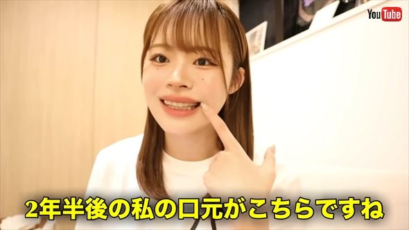 人気YouTuberのになにの歯列矯正ビフォーアフター