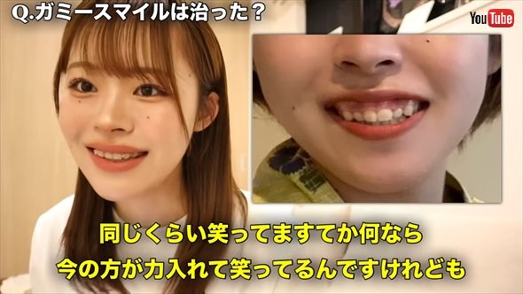 人気YouTuberのになにの歯列矯正ビフォーアフター