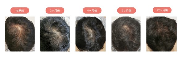 【PR】 クリニックフォア ／ AGA オンライン治療