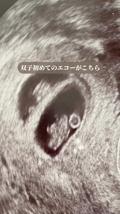 双子妊娠のエコー写真