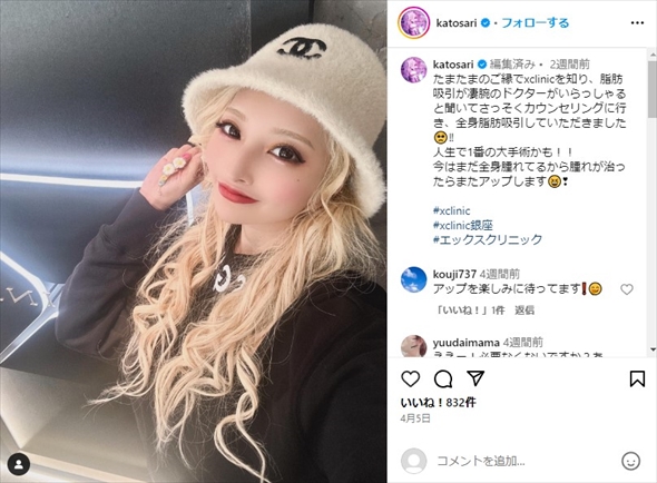 全身脂肪吸引を受けた加藤紗里