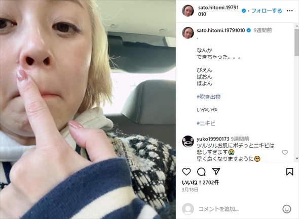 鼻のデキモノをみせる佐藤仁美