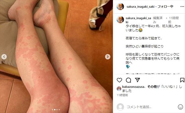 稲垣早希の蕁麻疹