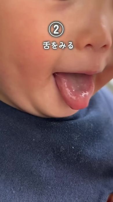 熱中症を防ぐために舌の状態を確認