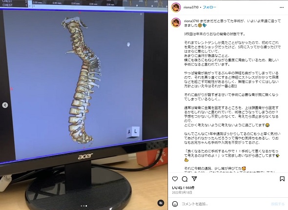 先天性疾患を持つ人気YouTubeのりおなちゃん