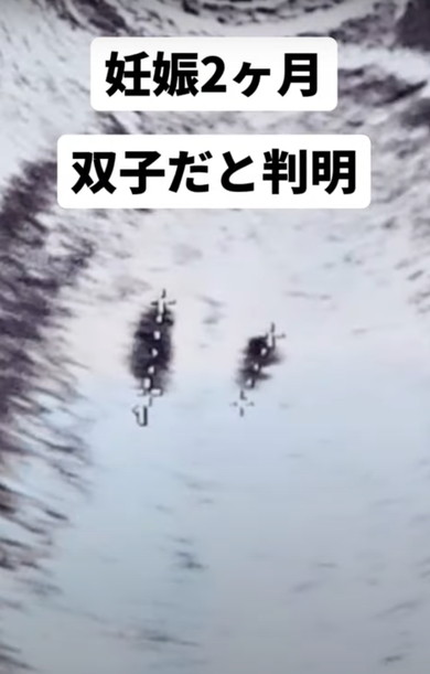 双子出産したママのお腹