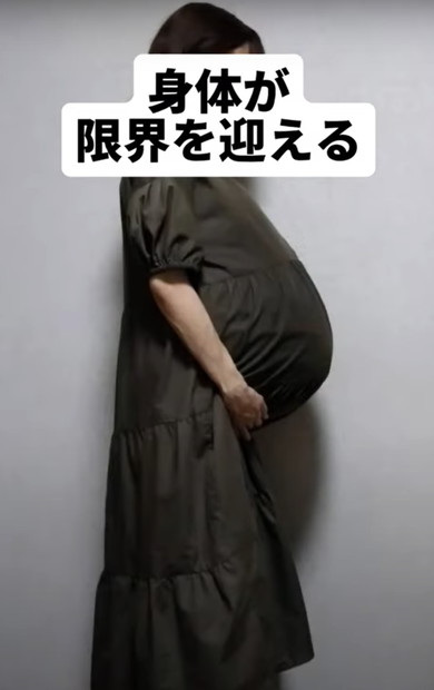 双子出産したママのお腹