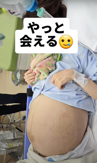 双子出産したママのお腹