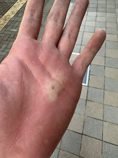 スズメバチに刺された手