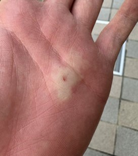 スズメバチに刺された手