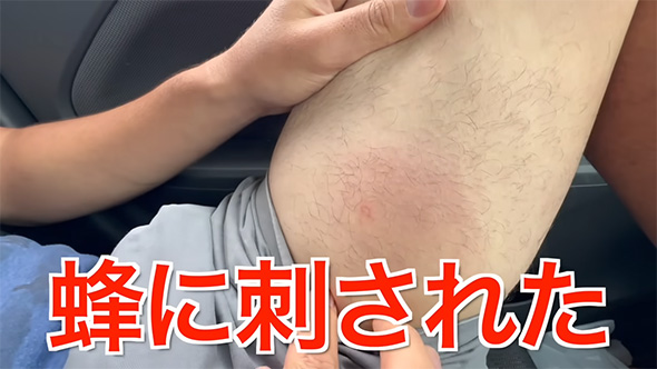 ハチに刺された