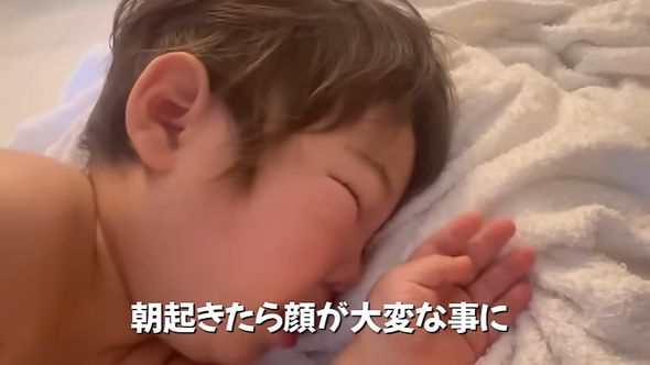 虫刺されのアレルギー反応により顔が腫れ上がってしまった息子