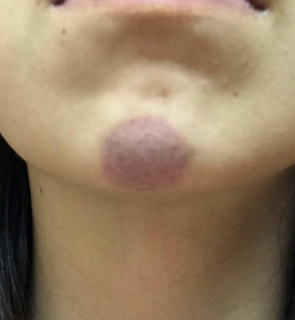 ペットボトルの水圧でついた跡