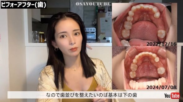 歯のビフォーアフター