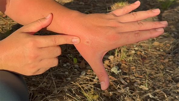 刺された患部を指さす