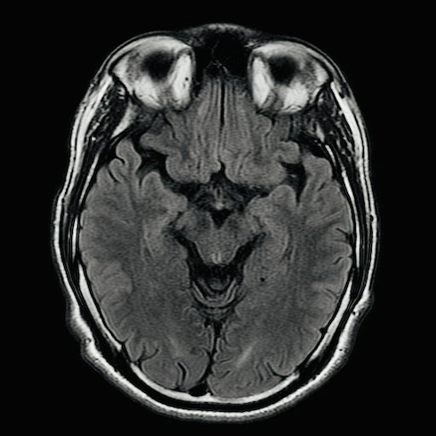 上からのMRI画像