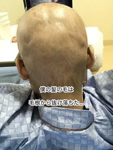 闘病中のえびなさん