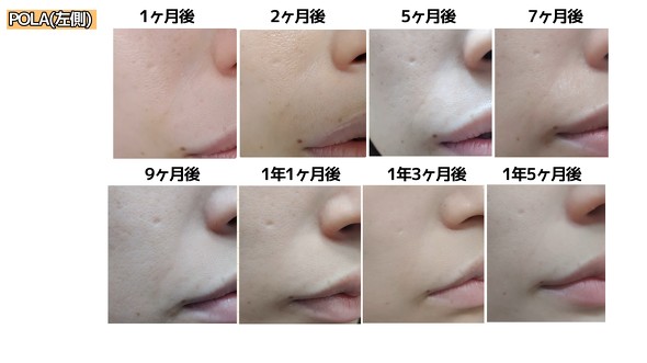 POLA肌写真