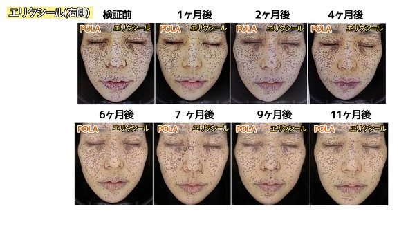 エリクシール美容皮膚科撮影写真