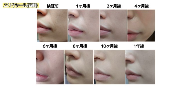 エリクシール肌写真