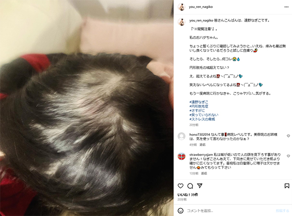 円形脱毛の遠野なぎこ